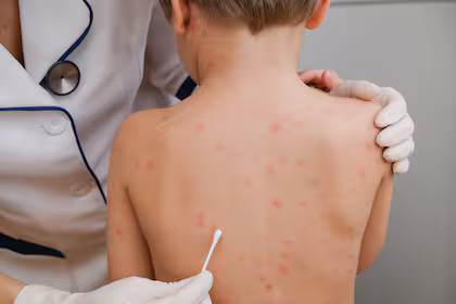 Aumentan casos de sarampión, 15 están en Cuauhtémoc y 1 en Namiquipa.