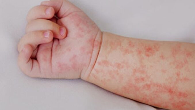 Informa Secretaría de Salud el fallecimiento de una bebé por sarampión