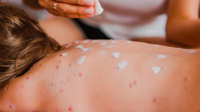 México registra 362 casos de sarampión, la mayoría en Chihuahua